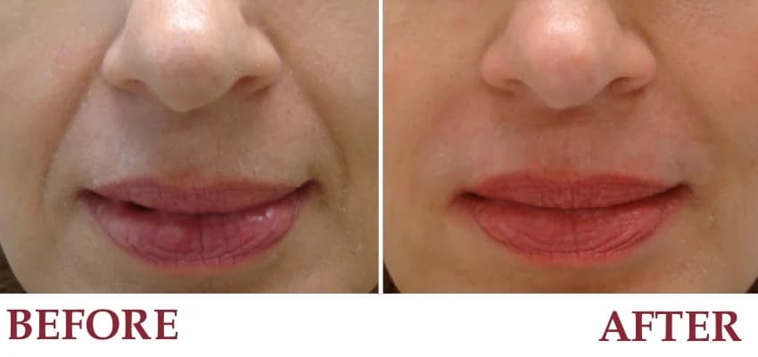 Un-retouched patient photograph — Nasolabial folds and marionette lines before & after Juvederm.