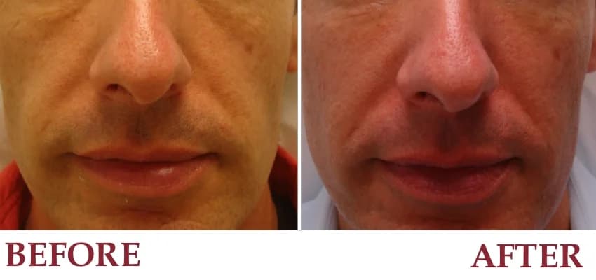 Un-retouched patient photograph — Mid cheek before and after Radiesse