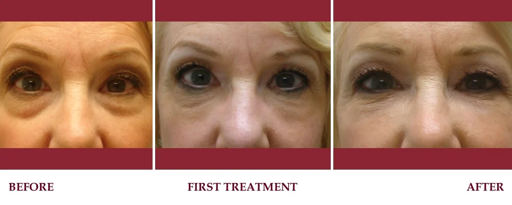 Un-retouched before and after patient photograph — “Bags” under the eyes improved without surgery.