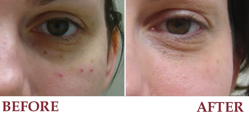 Un-retouched patient photograph — Angiomas on the cheek before and after laser treatment.