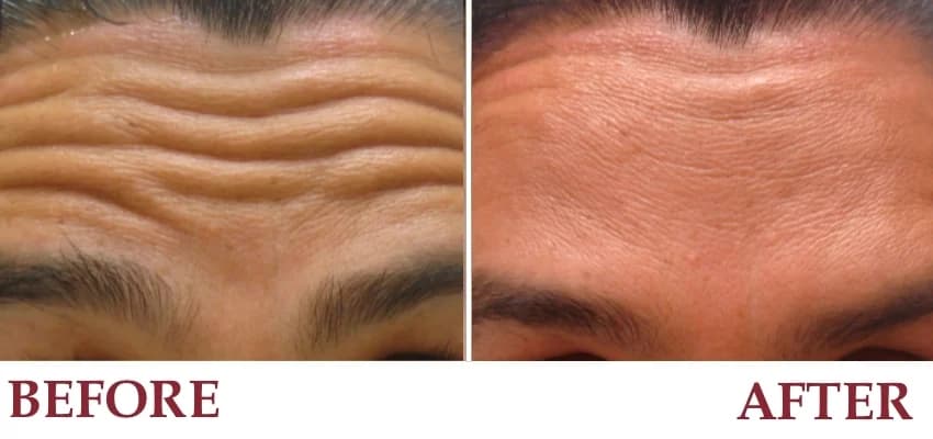 Un-retouched patient photograph — Raising eyebrows before and after BOTOX®.
