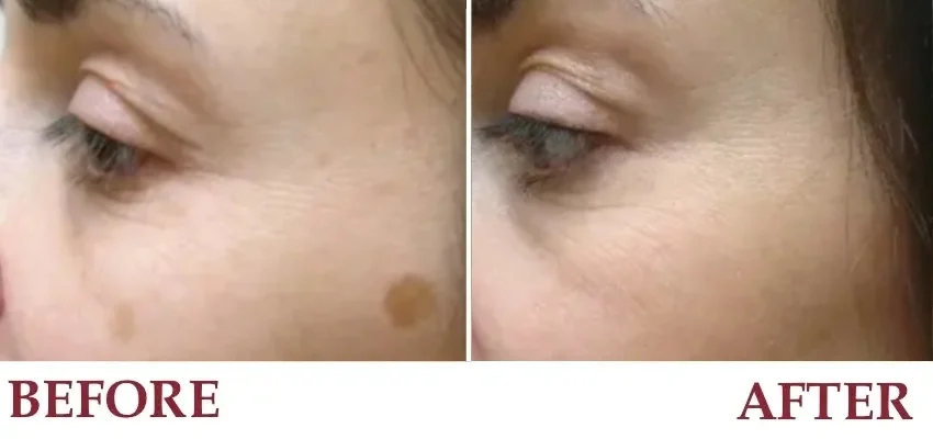Un-retouched patient photograph — Brown spots before and after laser treatment.