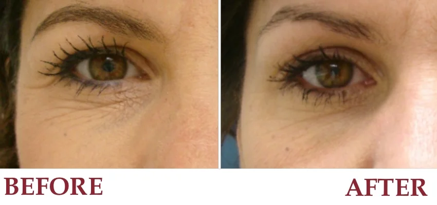 Un-retouched patient photograph — Crow’s feet and under eye creases before and after BOTOX®.