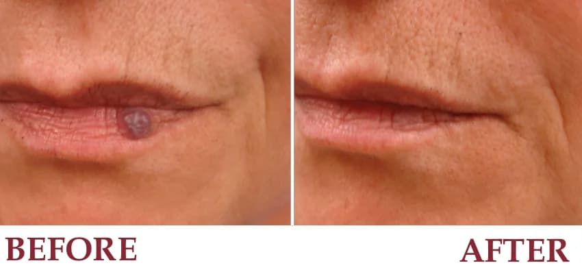 Un-retouched before and after patient photograph — Venous lake treated with pulse dye laser.