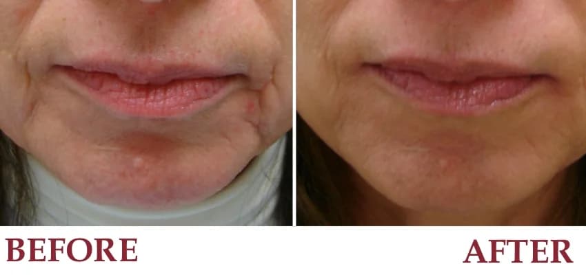Un-retouched before and after patient photograph — Marionette lines improved with filler treatment.