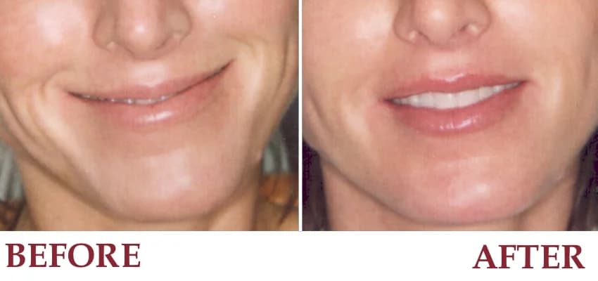 Un-retouched before and after patient photograph — Smile lines treated with Restylane®.