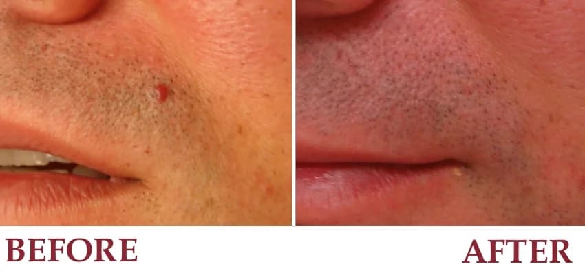 Un-retouched patient photograph — Angioma on the cheek before and after laser treatment.