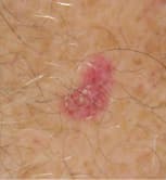 Skin Cancer Surgery at Dermatology and Skin Care Associates